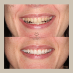 Composite Bonding Before and After Transformations | Re:Nu Dental & Medispa, Notting Hill, London