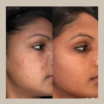 Before and After Mesotherapy Treatment for Face, Notting Hill, London