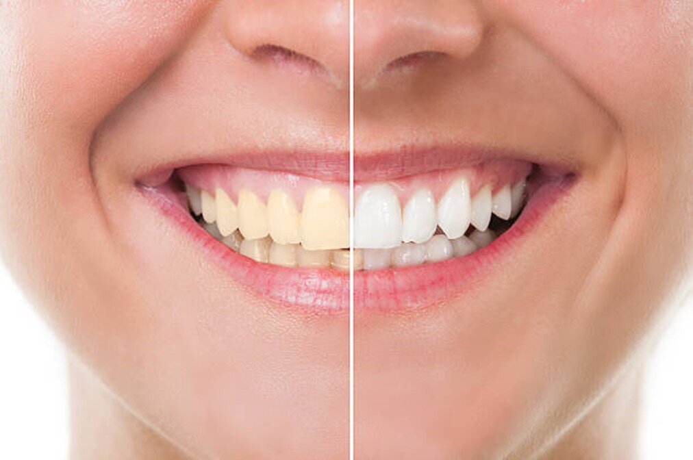Brightening smiles with professional teeth whitening at Re:Nu Dental & Medispa, Notting Hill.
