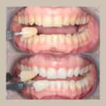 Before and after porcelain veneers, transforming smiles at Re:Nu Dental & Medispa, Notting Hill.