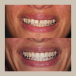 Dental Patients Before and after Invisalign treatment, transforming smiles at Re:Nu Dental & Medispa, Notting Hill
