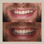 tooth repair with composite bonding procedure, before and after