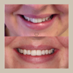 Before and after Invisalign, transforming smiles at Re:Nu Dental & Medispa, Notting Hill