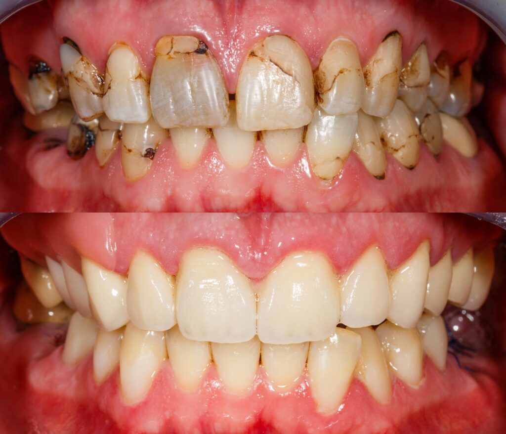 before and after treating a bad teeth