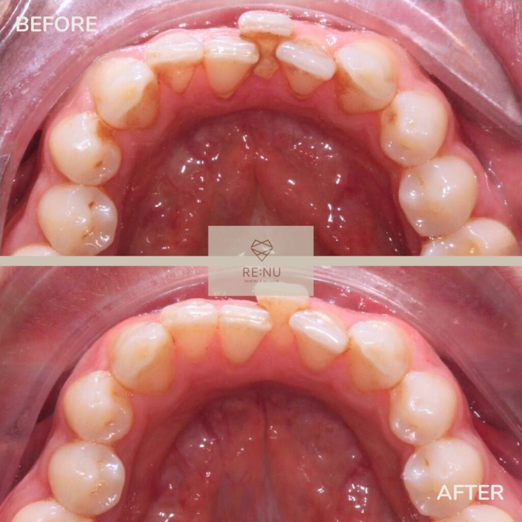 One of our patients struggled with plaque buildup due to crowded teeth. 🦷 A thorough hygiene appointment helped us identify areas that needed extra attention. By combining professional cleaning with targeted brushing and flossing techniques, our patient was able to achieve optimal oral health.